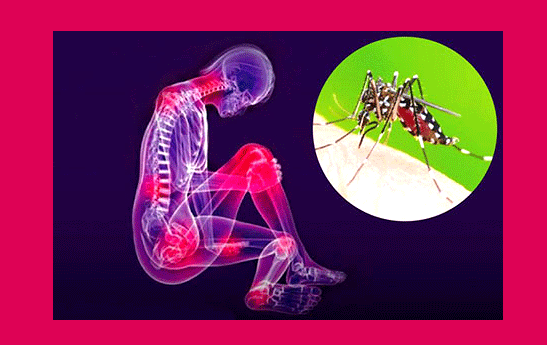 ویروس «چیکونگونیا»، علائم و راه‌های تشخیص