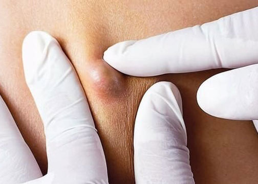 انواع کیست سینه در زنان و درمان آن