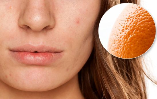 میزان اثرگذاری درمان پوست پرتقالی صورت با مزونیدلینگ