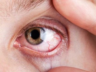 علت خشکی چشم، عوامل خطر و راه‌های درمان آن