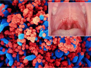 کروناویروس از طریق بزاق دهان هم منتقل می شود