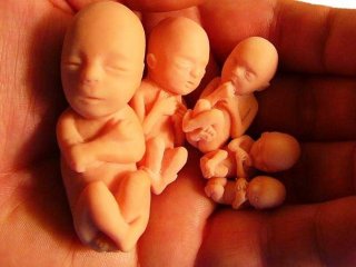 سقط مکرر و علت‌های آن