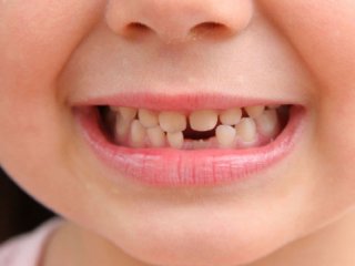 تغییر رنگ دندان‌ها در اثر مصرف قطره آهن