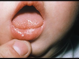 عفونت‌های ویروسی دهان و دندان