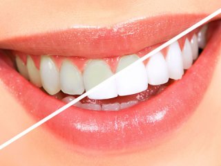 روش صحیح سفید كردن دندان (2)