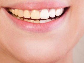شكستگی‌های ساده تاج و تاج ریشه در دندان‌های دائمی (1)