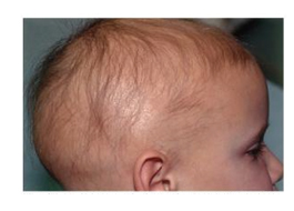 اختلالات مو در کودکان