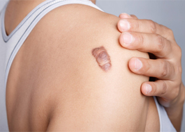 اقدامات ويژه درمانی در كلوييدهای پوستی