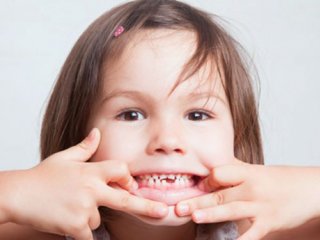 روکش دندان شیری چیست؟