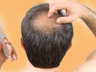 اثرات کمپلکس کافئین در جلوگیری از ریزش موی ارثی