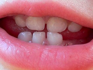 مراحل تکاملی دندان ها
