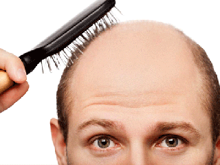 آیا ریزش مو ارثی قابل درمان است؟