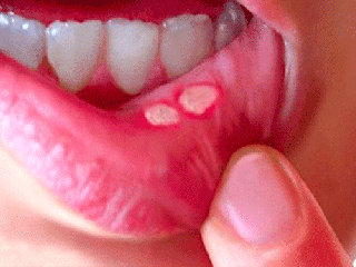 چه زمانی آفت دهان خطرناک است؟