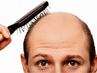 دلیل افزایش ریزش مو ارثی در تابستان چیست؟