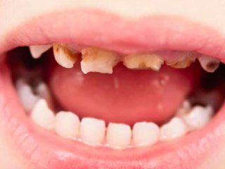 اختلالات ساختاری دندان ها و دلایل آنها