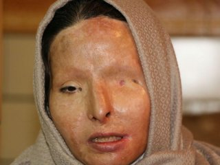 زنان قربانی اسید پاشی برای اولین بار در ایران مدل لباس شدند+عکس
