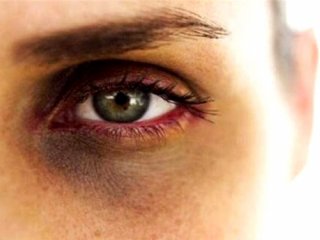 از بین بردن سیاهی دور چشم با چند روش‌ ساده