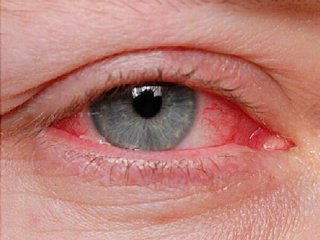 مراقب شایع‌ترین بیماری چشم در فصل گرما باشید