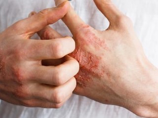 ۶ نشانه بیماری پوستی