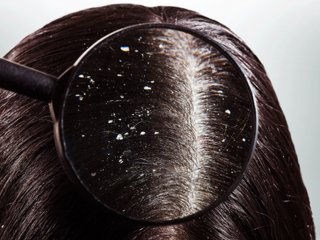 درمان شوره  در موهای چرب و خشک