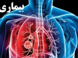 آخرین وضعیت بیماری سل در ایران