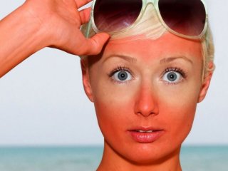10 درمان مؤثر برای آفتاب سوختگی