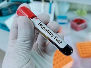 وزارت بهداشت: ۲۰۰ هزار ایرانی به هپاتیت C مبتلا هستند