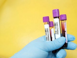 غربالگری سرطان پروستات با آزمایش خون ساده
