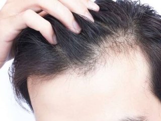 روش‌هایی برای جلوگیری از ریزش موی سر