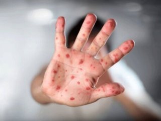 آخرین وضعیت «سرخک» در ایران؛ کودکان زیر ۵ سال سریع‌تر واکسن سرخک بزنند