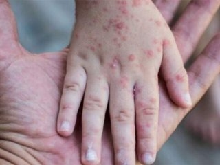 یک مقام وزارت بهداشت: «ما در معرض خطر بالای انتشار بیماری سرخک هستیم»