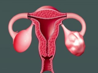 آیا تنبلی تخمدان خطر ابتلا به کرونا ویروس را در زنان افرایش می دهد؟