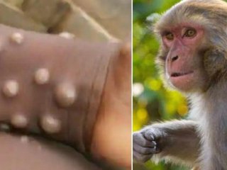 شناسایی ۶ بیمار مشکوک به آبله میمون در ایران