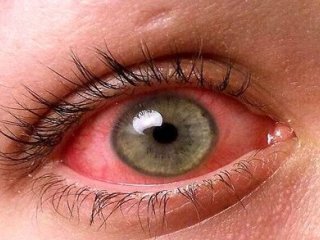 اگر قرمزی چشم دارید، چه زمانی باید به چشم پزشک مراجعه کنید؟