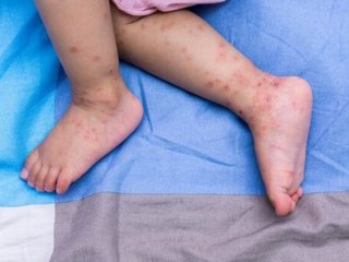 جزئیاتی درباره شیوع بیماری «دست و پا و دهان» ؛ کودکان اصلی‌ترین میزبان ویروس