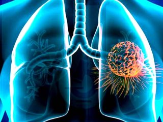 علایم سرطان ریه را بشناسید