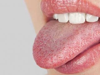 دهانشویه طبیعی برای درمان برفک دهان