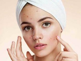 درمان جوش صورت با روش های طبیعی