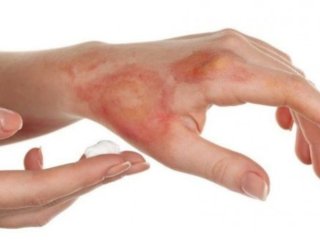 چند ترفند ساده برای درمان سوختگی؛ با این لبنیات سوزش پوست را تسکین دهید