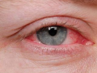استفاده از مواد ضدعفونی کننده چه خطراتی برایی چشم ها دارد؟