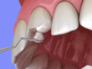 آیا مواد مورد استفاده در باندینگ دندان سرطان زا هستند؟
