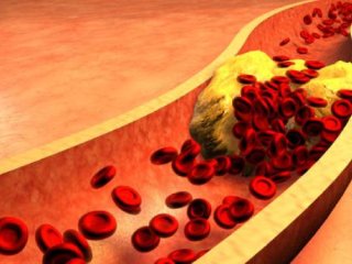 6 راهکار اساسی کاهش تری گلیسیرید خون