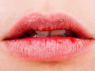 خشکی دهان نشانه کدام بیماری است؟