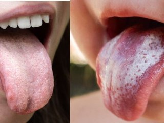 برفک دهان چیست؟ روش‌های خانگی برای درمان