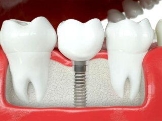 با مراحل ایمپلنت دندان آشنا شوید