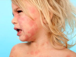 بیماری های پوستی شایع در کودکان