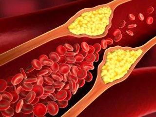 ۷ باور غلط درباره کلسترول خون