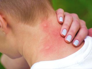 توصیه های پزشکی در آلرژی  به حشرات