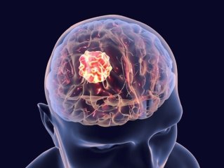 علائم و نشانه‌های هشداردهنده تومور مغزی چیست؟