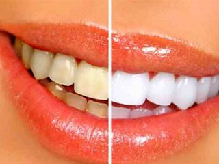اشتباهاتی که دندان‌های شما را زرد می‌کند